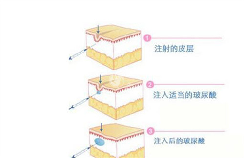 脸部抗衰项目性价比大比拼：价格+结果+维持时间全分析