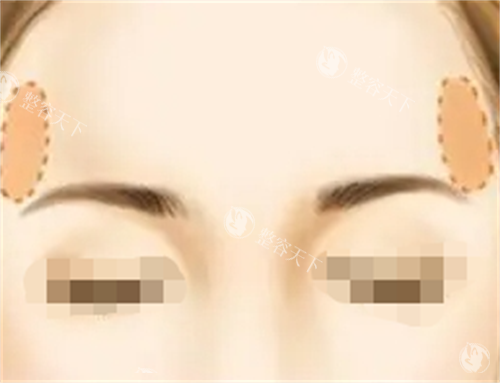 面部脂肪填充丰太阳穴动画展示图