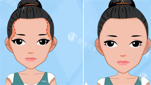 太阳穴凹陷前后对比图