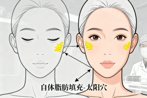 脂肪填充太阳穴卡通图