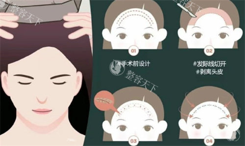 额头缩小手术过程