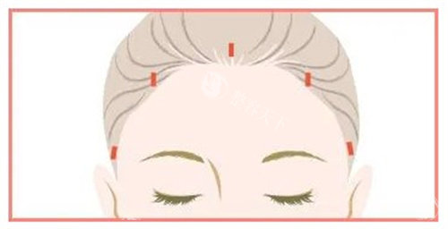 额头提升术切口