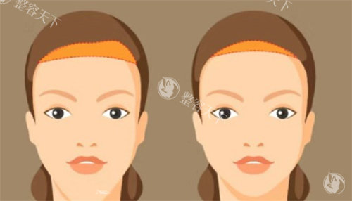 额头缩小手术对比