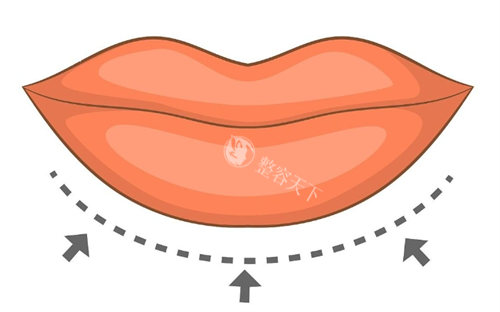 厚唇改薄画线示意图