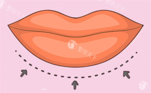 嘴唇缩小示意图