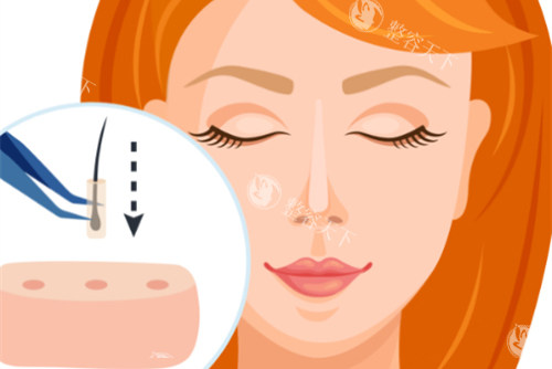 眉毛种植过程图解