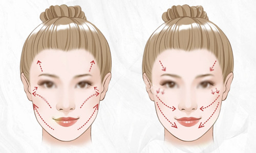 面部轮廓衰老下垂示意图
