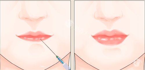 注射丰唇手术