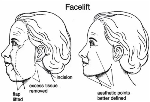 面部提升改善皮肤下垂等问题