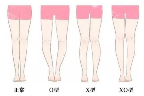 上海丽质整形直腿术怎么样?卢九宁医生多维平行纤腿术专治O型X型腿