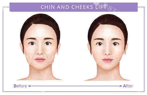 面部提升对比图