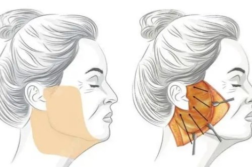 筋膜悬吊提升术卡通图