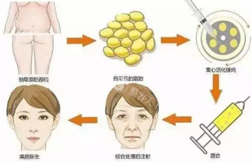 北京张大艳脂肪填充怎么样？成活率高，面部填充自然