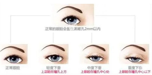 眼睑下垂程度