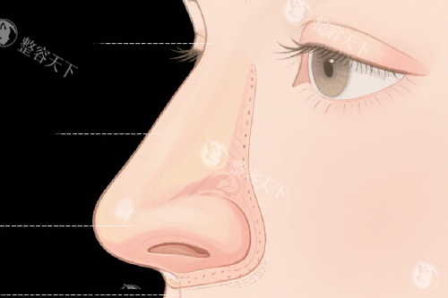 韩国葡聚糖生物肋骨鼻失败术例曝光！术后鼻梁歪斜、感染，这些风险你了解吗？