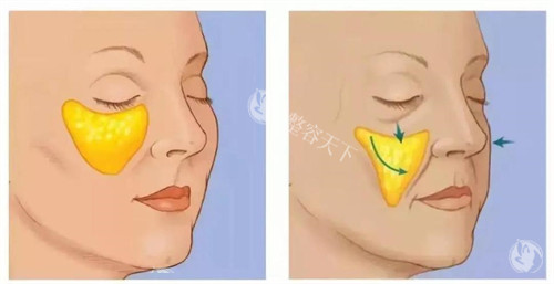 苹果肌下垂演示动画图