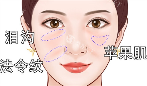 面部凹陷之后所呈现的面部状态