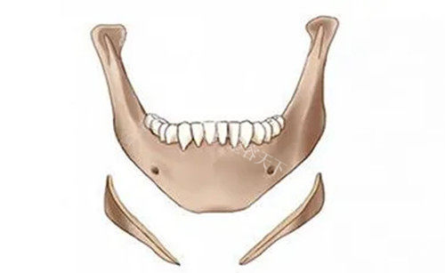 下颌角长曲线截骨示意图