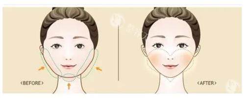 磨骨手术前后的区别