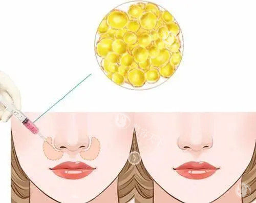 脂肪填充鼻基底位置示意图