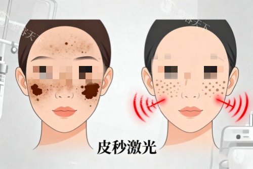 脸部做皮秒激光祛斑卡通图