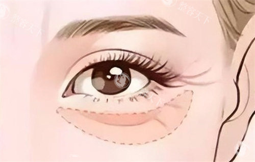 眼部填充胶原蛋白