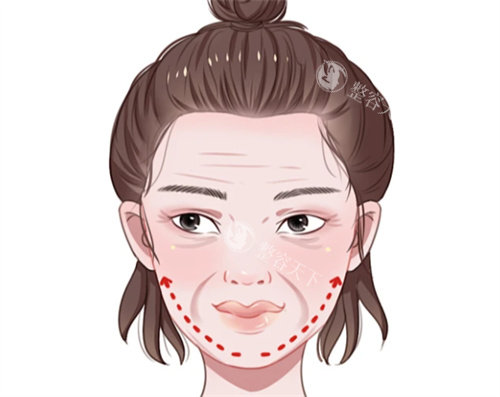 面部抗衰提升卡通图