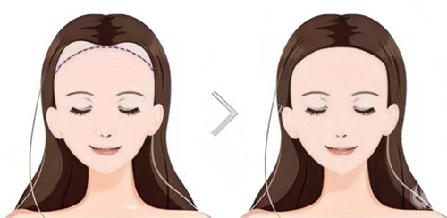 植发前后对比卡通图