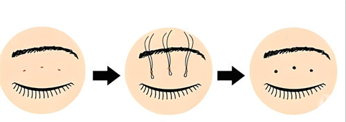 双眼皮三点术过程