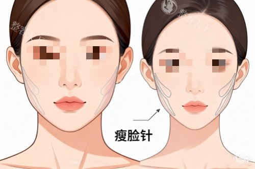 针剂注射瘦脸对比图