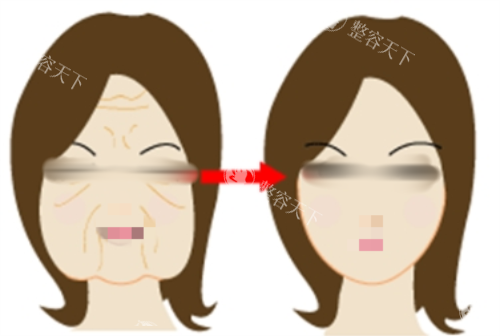 打针瘦脸前后对比图