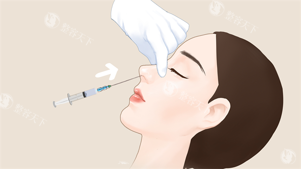 李青峰医生做鼻子到底怎么样？多年经验，技术在线，真实网友口碑好，打造自然，妈生感的鼻子~