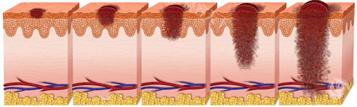 环钻切除疤痕手术成效好吗？要做几次？多少钱？深度解析疤痕环钻利弊评价