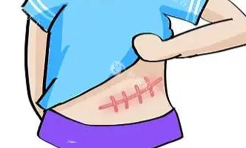 腹部疤痕增生的动画图