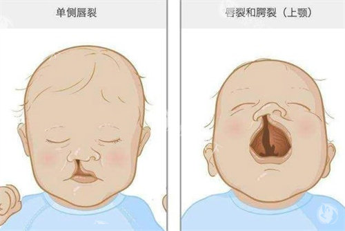唇裂宝宝家长必看！毛喆医生唇裂技术怎么样？1mm 精细缝合，疤痕淡到几乎看不见