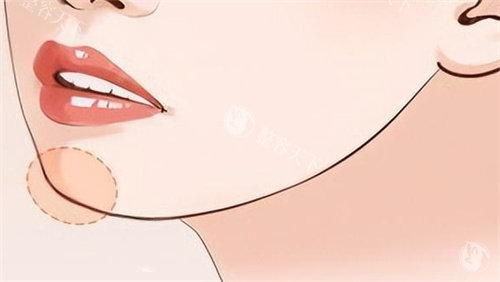 杭州找崔晶莹医生做玻尿酸丰唇是种什么体验？我亲历的“妈生感”美唇蜕变全记录！