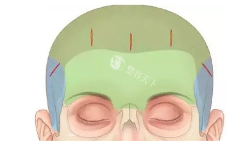 亲身讲述！我选择陈建忠医生做内窥镜额头提升的真实经历与年轻蜕变全过程~