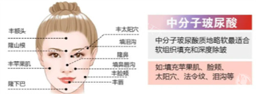 芙丽奈plUS玻尿酸属于什么档次？它究竟属于高端还是平价档位？