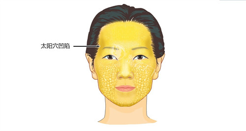 两千块搞定太阳穴凹陷：奥地利公主虽然吸收稍快但即刻结果超赞，平价女孩必入