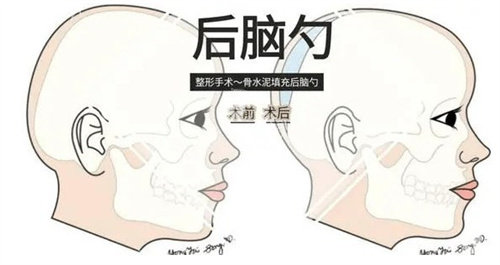 后脑勺填充手术前后
