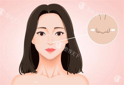 杭州盛飞缩鼻翼实力大揭秘，精细操作结果惊人，very 美学小程序速来围观！
