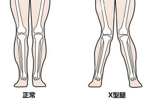 武汉想做x型腿矫正不知道选哪家靠谱？Very美学小程序帮你筛选正规机构避坑