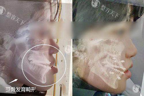 想做地包天正颌手术怕翻车，想提前看术后脸型改变真实术例？Very美学小程序汇总真实参考图