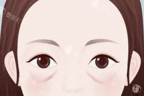 眼袋卡通展示图