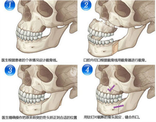 下颌骨劈开手术能切多少度啊，想做正颌的姐妹一定要先搞清楚这个问题！