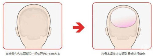 后脑勺整形手术图