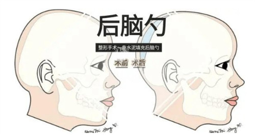 后脑勺填充对比