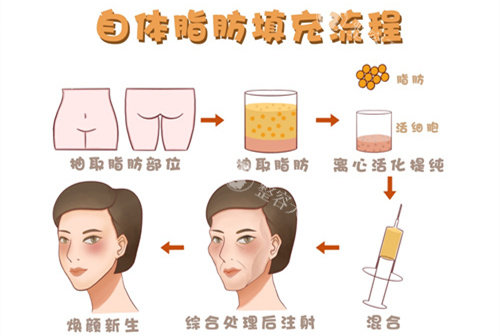 重庆毋巨龙医生做脂肪填充怎么样？存活率高吗？术例和收费情况整理好了