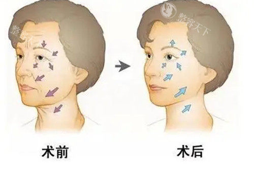 面部抗衰前后对比卡通示意图