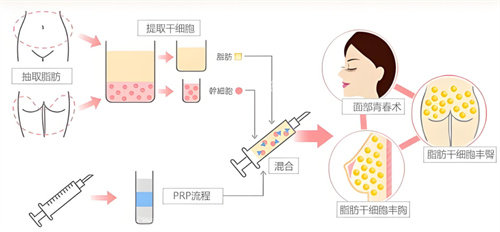自体脂肪隆胸花费随抽取填充方案存在差异，胸部基础不同定价区分清晰，上Very美学小程序对照自身情况摸清项目整体花费